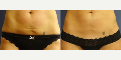 Woman treated with Fractora RF - Woman treated with Fractora RF