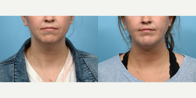 25-34 year old woman treated with Chin Implant - This 25-year-old patient turned to Dr. Wise with concerns about submental fullness and a weak chin that drew attention away from her other facial features. Six weeks after a combination chin implant and submental liposuction surgery, she is thrilled with her natural results, and especially with no longer having a double chin.