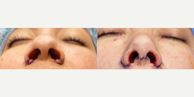 Septorhinoplasty with Alar Base Reduction - Septorhinoplasty with an Alar Base Reduction - We streamlined our patients nose while narrowing the nostrils.