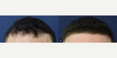 Man treated with PRP for Hair Loss - Man treated with PRP for Hair Loss