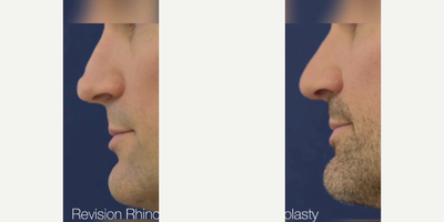 Man treated with Revision Rhinoplasty - Our patient experienced a botched rhinoplasty from previous surgery. We corrected a significant defect with a customized revision rhinoplasty under a general anesthetic. The before and after photos highlight the improvement we made to his nose.Treatment: Revision Rhinoplasty.Purpose: Used to change the appearance of the nose, improve breathing, or both.Note: Individual results may vary.Time: 1-3 hours.Anesthesia: General anesthetic.Recovery: 7-10 days.