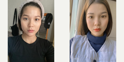 25-34 year old woman treated with Cheekbone Reduction - Square Jaw Reduction Surgery (V-line Surgery)Zygomatic Bone Surgery