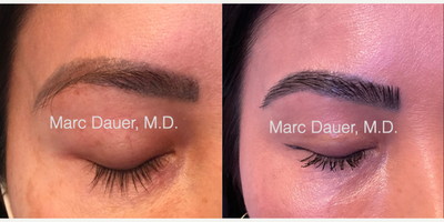 Woman treated with Eyebrow Transplant - Woman treated with Eyebrow Transplant