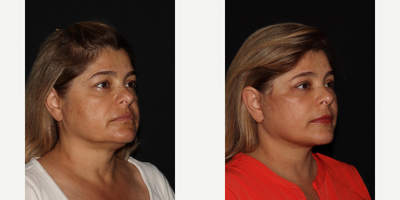 55-64 year old woman treated with Facelift, Eyelid Surgery, Laser Resurfacing, Facial Fat Transfer, Rhinoplasty - MD Restore, Deep-Plane (Additional Procedures: Eyelids, Laser Resurfacing, Fat Transfer, Rhinoplasty)