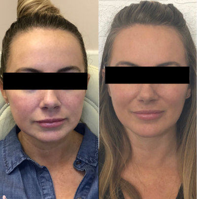 35-44 year old woman treated with Microneedling - A before and after of Microneedling with AquaGold techniques. The AquaGold uses a specialized device to deliver Botox, Hyaluronic Acid (what fillers are generally made of), and a personalized vitamin cocktail (in this case Vitamin B-12 Plus). AquaGold is Kim Kardashian's pre-Met Gala secret. By using a hand-powered device our estheticians are able to guide the serum into the upper layer of the skin. The micro-needling causes the skin to appear plumper and quicken the regeneration rate for a fresh-looking face, while the serums tighten the skin, cause the pores to shrink, and give your skin an incredible glow that can last for months. Optimum effects appear after 3 days.