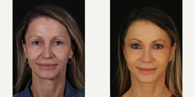 45-54 year old woman treated with Facelift, Facial Fat Transfer - Facelift, fat transfer B&A.
