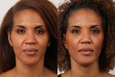 45-54 year old woman treated with LaseMD - This patient had a LaseMD treatment to help with overall texture and fine lines. The great thing about LaseMD is that it's safe for all skin types!