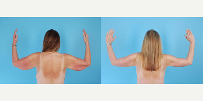 45-54 year old woman treated with Arm Lift - A 54 year old woman before and after an arm lift by Andrew T. Lyos M.D FACS. She managed to lose 150 pounds through diet and exercise within 6 months. Due to the extensive weight loss, her arms became saggy with excess skin.