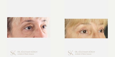 45-54 year old woman treated with Eyelid Surgery - Upper and Lower Eyelid Surgery (Blepharoplasty)