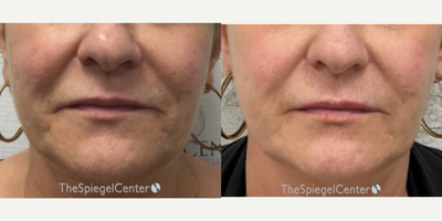 55-64 year old woman treated with Ellacor - Ellacor