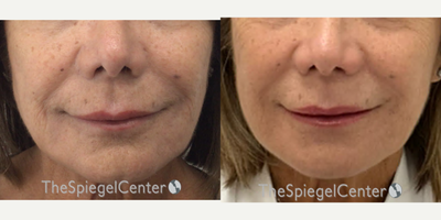 65-74 year old woman treated with Ellacor - Ellacor