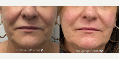 55-64 year old woman treated with Ellacor - Ellacor