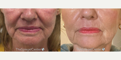 65-74 year old woman treated with Ellacor - Ellacor