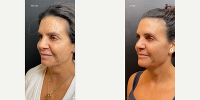 Woman treated with Sylfirm X, Renuva - SylfirmX + Renuva are an excellent combo! Lift, improve texture and tone of your skin with some of our favorite treatments