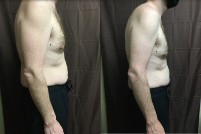 35-44 year old man treated with Evolve - 35-44 year old man treated with Evolve