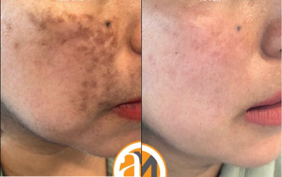 45-54 year old woman treated with Cosmelan - Our patient had a Cosmelan MD chemical peel treatment to address stubborn melasma and skin hyperpigmentation.