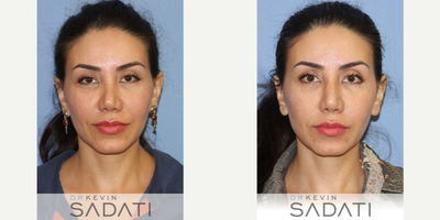 35-44 year old woman treated with Non Surgical Rhinoplasty - Non surgical rhinoplasty using Voluma