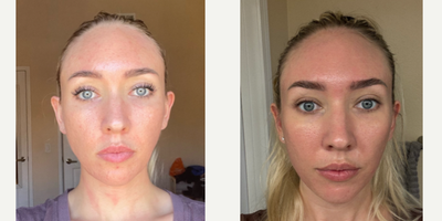 ACNE SCARS & GLACIAL - Our patient has been with us before way back in 2019 and she absolutely loved the progress her skin saw. Shes back to further improve her acne scars with a combination of Bellafill, TCA Cross, CO2, and GLACIAL. Following her treatment, we applied PDO AFTERGLO to her face to provide further smoothing and hydration to her irritated skin.What is GLACIAL?Glacial is a best in class device that is phenomenal for soothing the skin post treatment. It draws the heat from the skin and delivers a wondrously cooling sensation. It quells inflammation and works perfectly with @emer.skin products. @glacial_rx was the cherry on top for this patient and she loved how calming and soothing it was.No treatment is complete without EMER SKIN. Using our products post-treatment will enhance results to the absolute maximum. Click Link in Bio Click Emer Skin