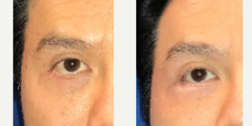 45-54 year old man treated with Eyelid Surgery - This gentleman had a unilateral eyelid retraction so we corrected it with a canthopexy. Pay attention to the left side corner of the eye and lid direction.&nbsp;