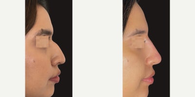 25-34 year old gender nonconforming person treated with Nonsurgical Nose Job - Dreaming of a more balanced profile?  A non-surgical nose job might be just what you need! Using strategically placed dermal fillers, we can: Camouflage bumps for a smoother contour Lift the tip for a refined look Harmonize your nose with the rest of your beautiful featuresNo surgery, no downtimejust instant, natural-looking results! 