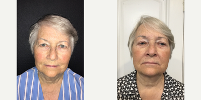 Woman treated with Eyelid Surgery, Mini Facelift - Woman treated with Eyelid Surgery, Mini Facelift