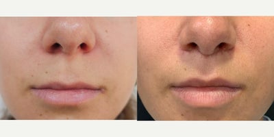 18-24 year old woman treated with Lip Surgery - Lip Lift 3 weeks post operative