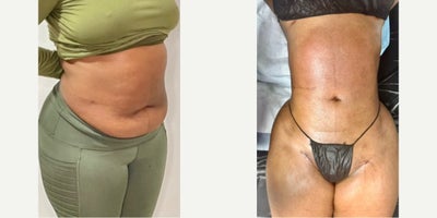 25-34 year old woman treated with Liposuction, BodyTite, Brazilian Butt Lift, Hip Augmentation - 25-34 year old woman treated with Liposuction, BodyTite, Brazilian Butt Lift, Hip Augmentation