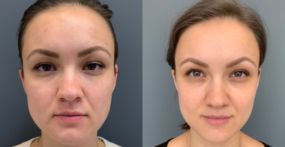 25-34 year old woman treated with ResurFX - The Lumenis M22 laser was used to preform the ResurFX procedure on this woman. Effects were seen after the very first session (4 sessions are usually recommended for max results). Redness and uneven skin tone was were targeted in this treatment and the result is a beautiful, glowing complexion.