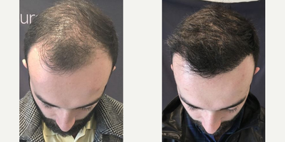 25-34 year old man treated with NeoGraft - NeoGraft