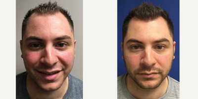 25-34 year old man treated with NeoGraft - NeoGraft