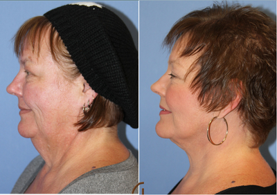 Neck lift under local anesthesia and twilight sedation - This patient was unhappy with appearance of her neck and jowls. She had a neck lift performed in office, under local anesthesia and twilight sedation - no general anesthesia was required.&nbsp;