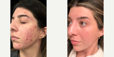 18-24 year old woman treated with Laser Resurfacing, Chemical Peel, Glycolic Peel, IPL, Jessner Peel, BroadBand Light (BBL) - Female, Fitzpatrick 3Treated: Acne, Acne Scaring, InflammationTreatment: 3 Forever Clear Treatments, Transformation Peel, Extractions, Customized Skin Care Plan