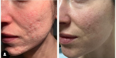 Woman treated with MiXto Laser, CO2 Laser, Laser Resurfacing - Woman treated with MiXto Laser, CO2 Laser, Laser Resurfacing