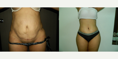 25-34 year old woman treated with Tummy Tuck Revision - Patient 31 year old with a previous tummy at age of 21. She had another pregnancy 2 years ago and her abdomen got stretch with a moderate rectum muscle diatesis. She was treated with a low scar technique, muscle repair and liposuction on the flanks.