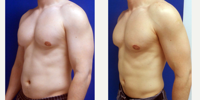 25-34 year old woman treated with Male Breast Reduction - Gynecomastia