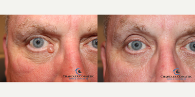 55-64 year old man treated with Cyst Removal - 64 year-old man with a large benign (non-harmful) cyst of his right lower eyelid. Despite how unsightly this cyst was, it caused him no harm. He desired cosmetic removal and underwent an in-office eyelid cyst removal. Patients such as this gentleman are often very nervous to have a doctor work so close to their eye or to end up with a disfiguring scar. His after mole removal surgery photo is unaltered and unretouched. This is the reason that eye doctors, plastic surgeons, and dermatologists from all over the Philadelphia and South Jersey area refer to Dr. Chandler. These results are why patients travel great distances for his expertise. After cyst removal this man has minimal scarring, no distortion of his eyelid and he was most appreciative of Dr. Chandlers top cosmetic surgery outcomes.