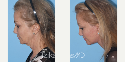 65-74 year old woman treated with Facelift - Extended Deep Plane Facelift, Full face eCO2 laser resurfacing & Lip lift