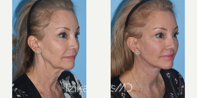 65-74 year old woman treated with Facelift - Extended Deep Plane Facelift, Full face eCO2 laser resurfacing & Lip lift