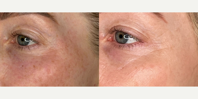 25-34 year old woman treated with Microneedling, SkinPen - patient treated with series of microneedling treatments