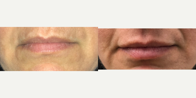 45-54 year old woman treated with Juvederm - Juvederm injection in the lower lip on this middle-aged woman.