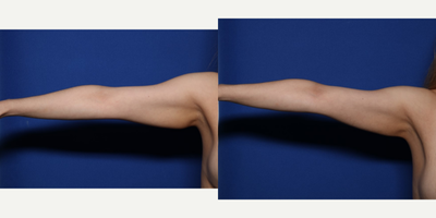 25-34 year old woman treated with BodyTite, Morpheus8 - 32 year old female shown 6 weeks after BodyTite lipo to her abdomen, flanks, and arms along with Morpheus8 RF microneedling.