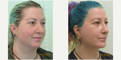40+ year old woman treated with Neck Lift & Lower Facelift - This woman presented with the complaint of genetic heaviness in her lower face and neck. She stated that even with weight loss the fullness of her lower face and neck never seem to improve. She had attempted a few treatment of ultherapy and radiofrequency without any substantial improvement and wanted a more permanent, and significant, solution.We agreed that a lower facelift and necklift (with liposuction) would be the best treatment. Under local anesthesia and oral sedation with xanax, we performed a lower facelift and necklift in less than two hours (surgical time).Her results demonstrate significant reduction in the overall heaviness of her face, while creating much better angles to her jawline and profile.