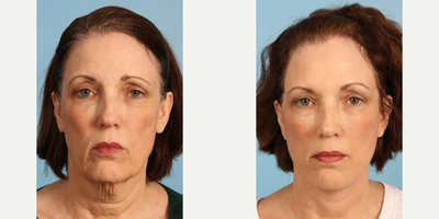 64 year old woman treated with Cheek Lift - A 64 year-old woman before and after Cheek and Neck Lift with Platysmaplasty by Andrew T. Lyos M.D., FACS.