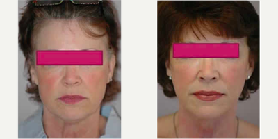 Neck Lift - Neck Lift