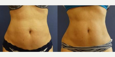 Woman treated with SculpSure - Woman treated with SculpSure