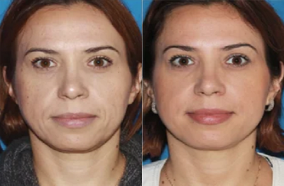 Non-surgical Facial Rejuvenation - 	Non-surgical facelift rejuvenates the face improve the wrinkles around the mouth.
