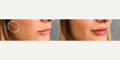 Woman treated with Lip Augmentation - Woman treated with Lip Augmentation using Juvederm