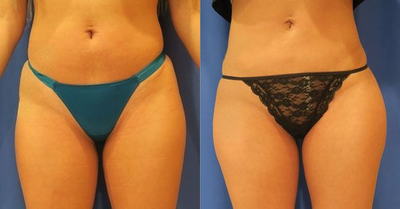 Woman treated with Butt Implants - Woman treated with Butt Implants