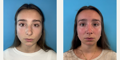 18-24 year old woman treated with Rhinoplasty, Septoplasty - Im happy to share this young ladys 9 month results following her Rhinoplasty and Septoplasty.Full views are shown. Please notice the almost invisible incision in the columella in the worms eye view (when she looks up), how the tip stays in the perfectposition even when smiling, and how the tip closely resembles the initial postoperative results in the operating room (in the final photo).It takes 12-18 months for all the nose swelling to come down, during which time I see patients in the office every 2-3 months for steroid injections to accelerate the swelling resolution. The overall goal is to always maintain a natural result. Key maneuvers included a component hump reduction, reverse angulated caudal septal trim, tip deprojection with a columellar strut graft, spreader grafts, alar contour grafts, and a mastoid fascia tip graft  the multiple cartilage grafts were used to help provide long-term stability and structure to maintain the aesthetic and functional goals.