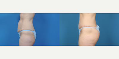 35-44 year old woman treated with Circumferential Tummy Tuck - 35-44 year old woman treated with Circumferential Tummy Tuck